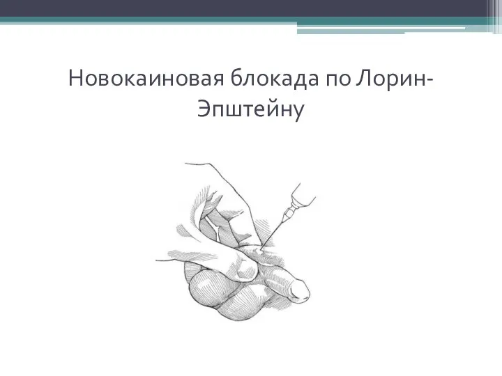 Новокаиновая блокада по Лорин-Эпштейну