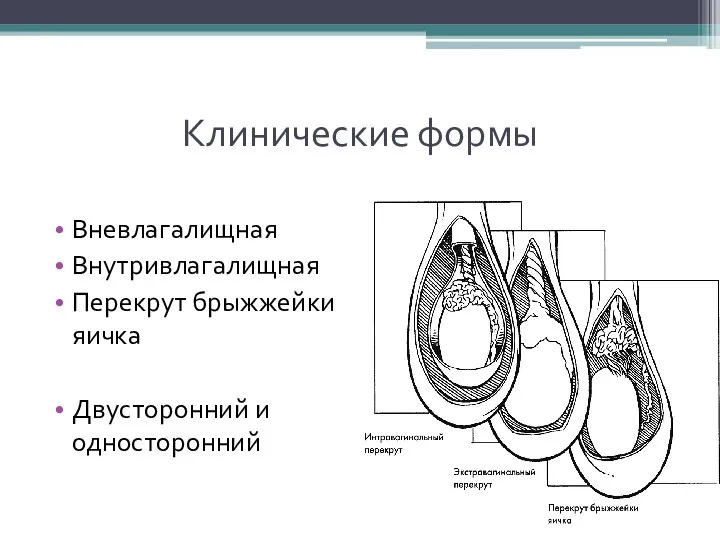 Клинические формы Вневлагалищная Внутривлагалищная Перекрут брыжжейки яичка Двусторонний и односторонний