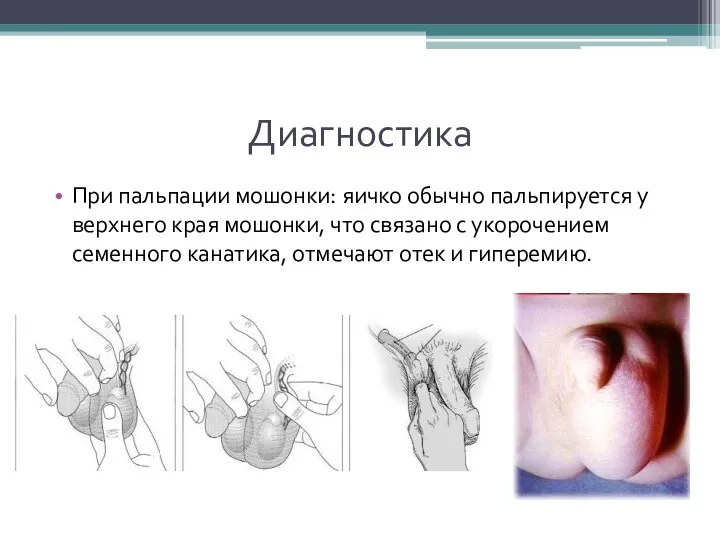 Диагностика При пальпации мошонки: яичко обычно пальпируется у верхнего края мошонки, что