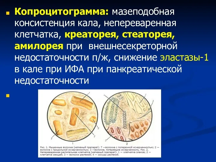 Копроцитограмма: мазеподобная консистенция кала, непереваренная клетчатка, креаторея, стеаторея, амилорея при внешнесекреторной недостаточности