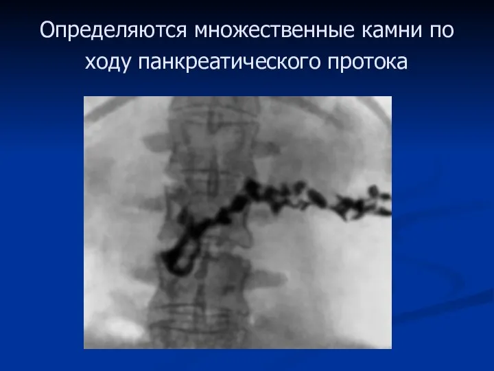 Определяются множественные камни по ходу панкреатического протока