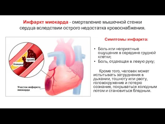 Инфаркт миокарда - омертвление мышечной стенки сердца вследствии острого недостатка кровоснабжения. Симптомы