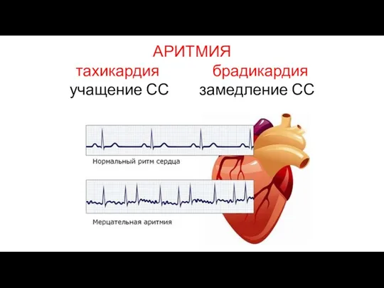 АРИТМИЯ тахикардия брадикардия учащение СС замедление СС