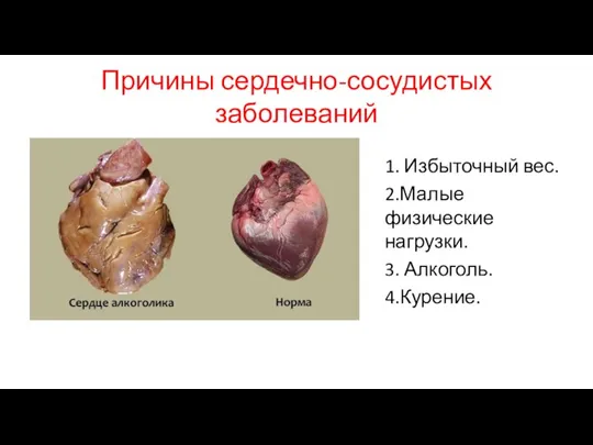 Причины сердечно-сосудистых заболеваний 1. Избыточный вес. 2.Малые физические нагрузки. 3. Алкоголь. 4.Курение.