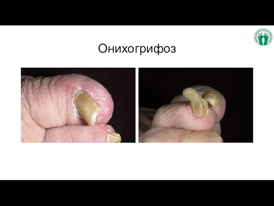 Онихогрифоз