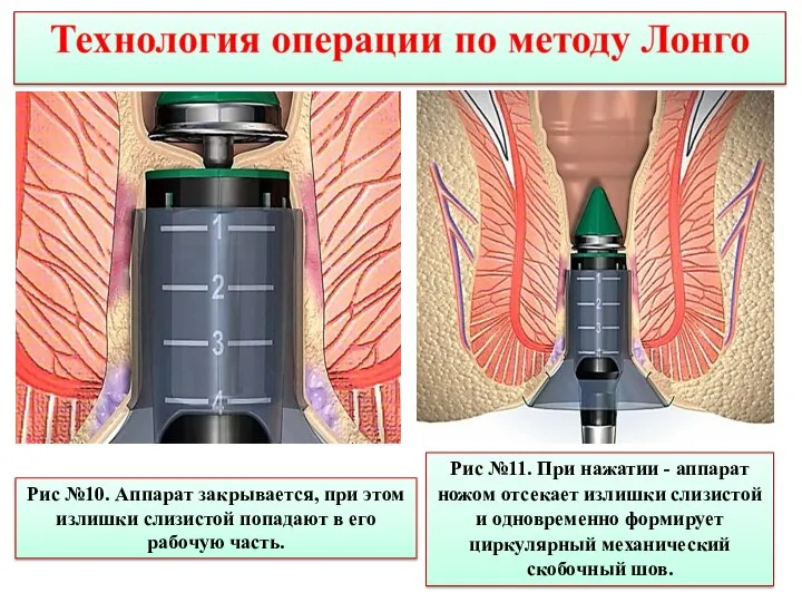 Рис №10. Аппарат закрывается, при этом излишки слизистой попадают в его рабочую