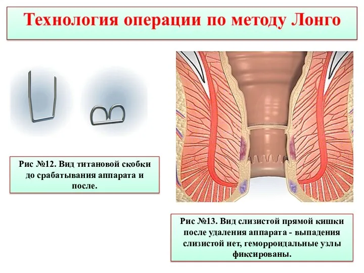 Рис №12. Вид титановой скобки до срабатывания аппарата и после. Рис №13.