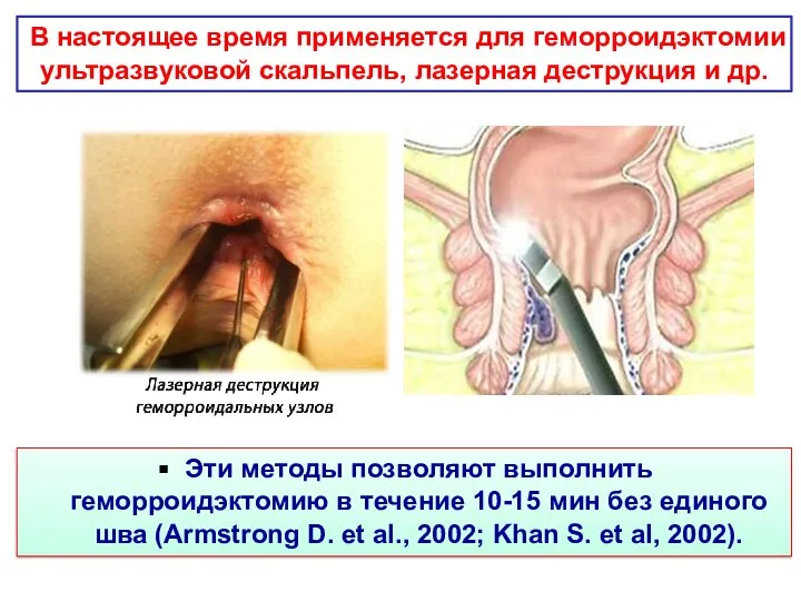 Эти методы позволяют выполнить геморроидэктомию в течение 10-15 мин без единого шва