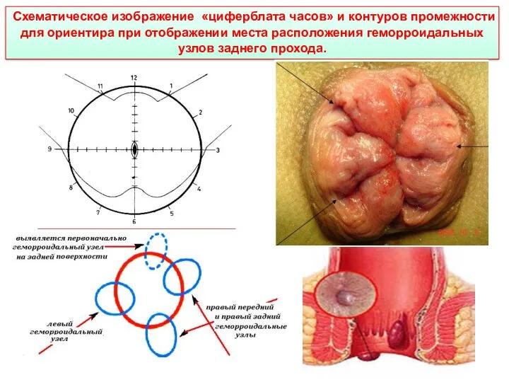 Схематическое изображение «циферблата часов» и контуров промежности для ориентира при отображении места