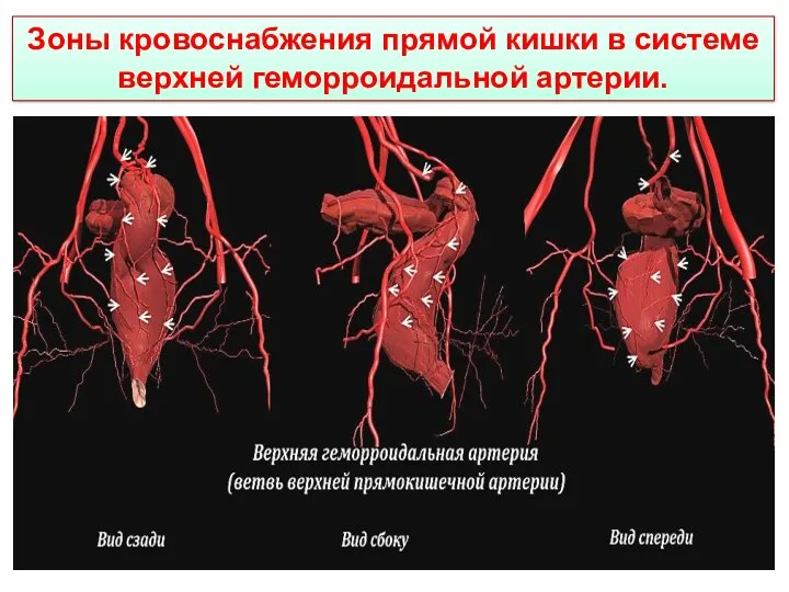 Зоны кровоснабжения прямой кишки в системе верхней геморроидальной артерии.