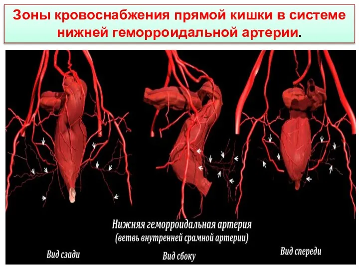 Зоны кровоснабжения прямой кишки в системе нижней геморроидальной артерии.