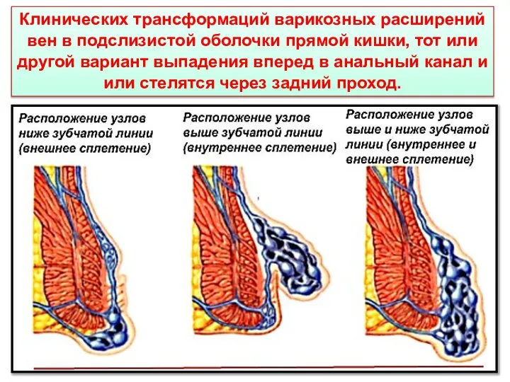 Клинических трансформаций варикозных расширений вен в подслизистой оболочки прямой кишки, тот или