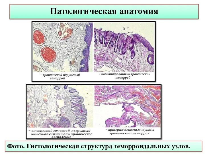 Патологическая анатомия Фото. Гистологическая структура геморроидальных узлов.