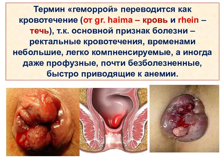 Термин «геморрой» переводится как кровотечение (от gr. haima – кровь и rhein