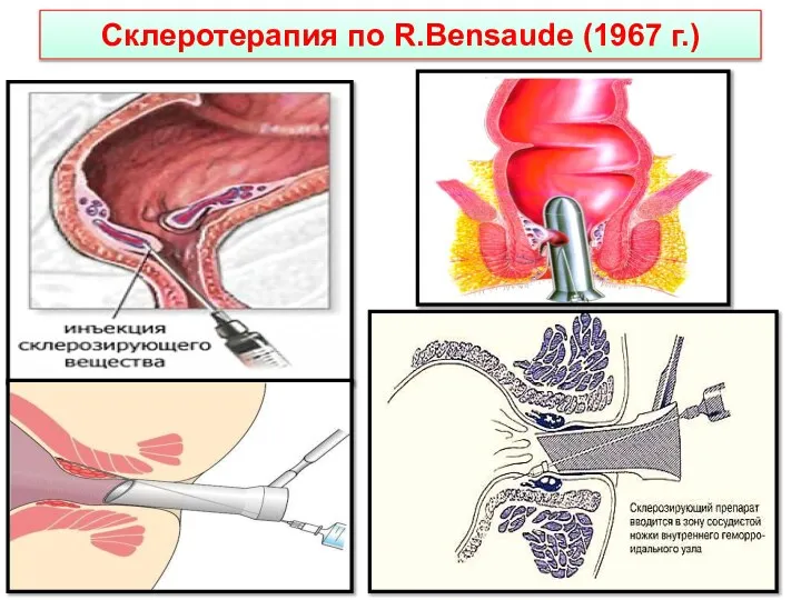 Склеротерапия по R.Bensaude (1967 г.)