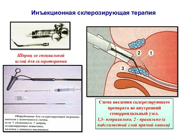 Инъекционная склерозирующая терапия Схема введения склерозирующего препарата во внутренний геморроидальный узел. 1,3-