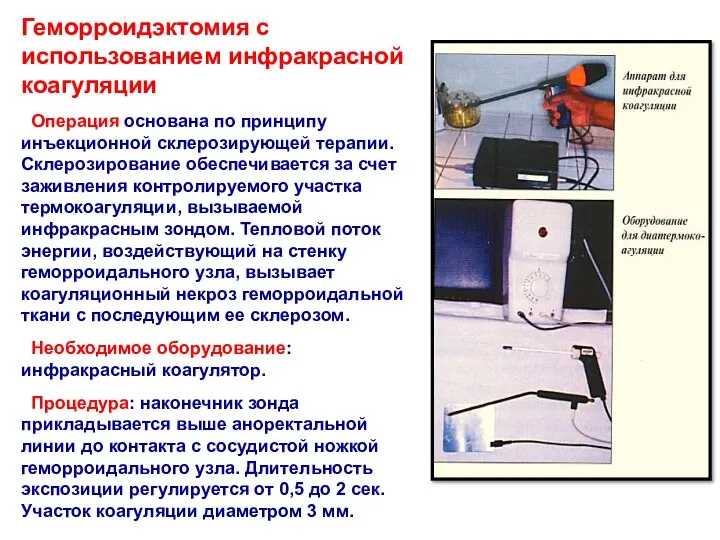 Геморроидэктомия с использованием инфракрасной коагуляции Операция основана по принципу инъекционной склерозирующей терапии.