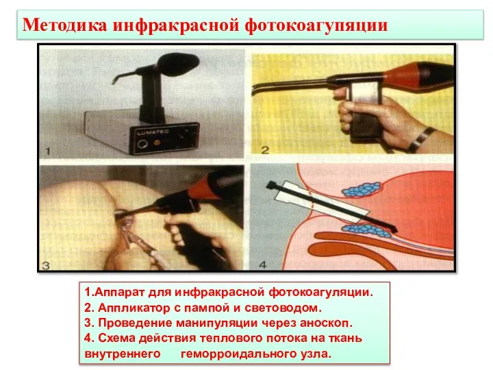 Методика инфракрасной фотокоагупяции 1.Аппарат для инфракрасной фотокоагуляции. 2. Аппликатор с пампой и