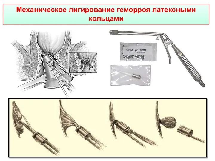 Механическое лигирование геморроя латексными кольцами