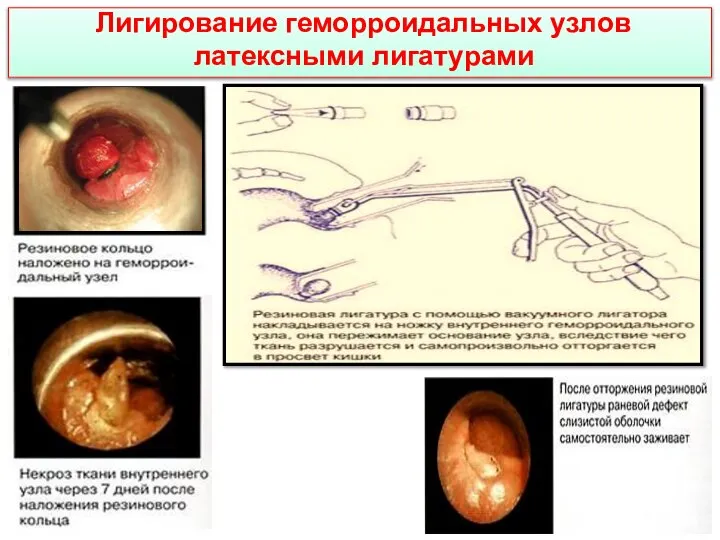 Лигирование геморроидальных узлов латексными лигатурами