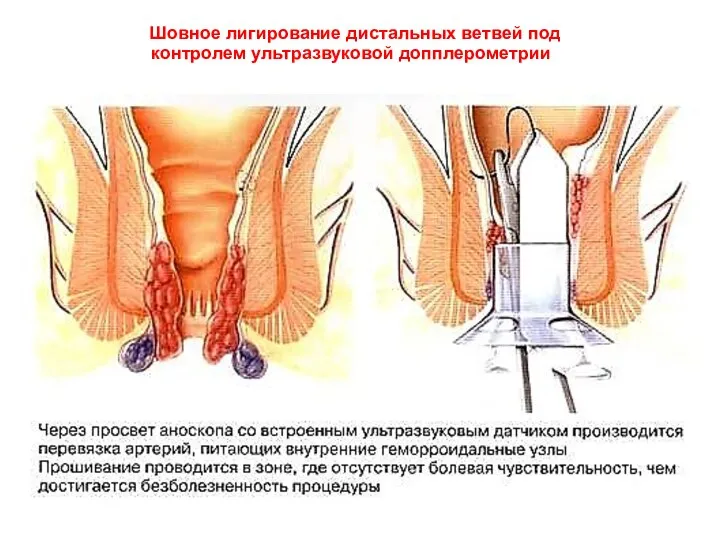 Шовное лигирование дистальных ветвей под контролем ультразвуковой допплерометрии