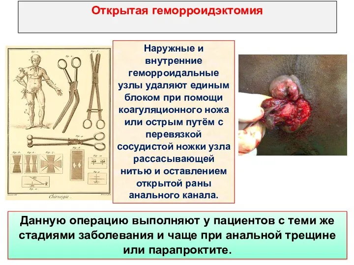 Открытая геморроидэктомия Наружные и внутренние геморроидальные узлы удаляют единым блоком при помощи