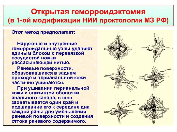 Открытая геморроидэктомия (в 1-ой модификации НИИ проктологии МЗ РФ) Этот метод предполагает: