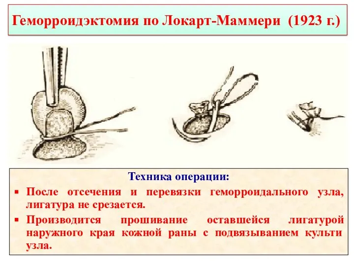 Геморроидэктомия по Локарт-Маммери (1923 г.) Техника операции: После отсечения и перевязки геморроидального