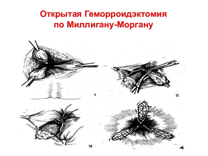 Открытая Геморроидэктомия по Миллигану-Моргану