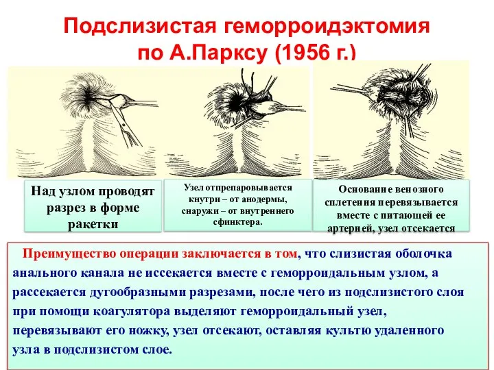 Подслизистая геморроидэктомия по А.Парксу (1956 г.) Преимущество операции заключается в том, что