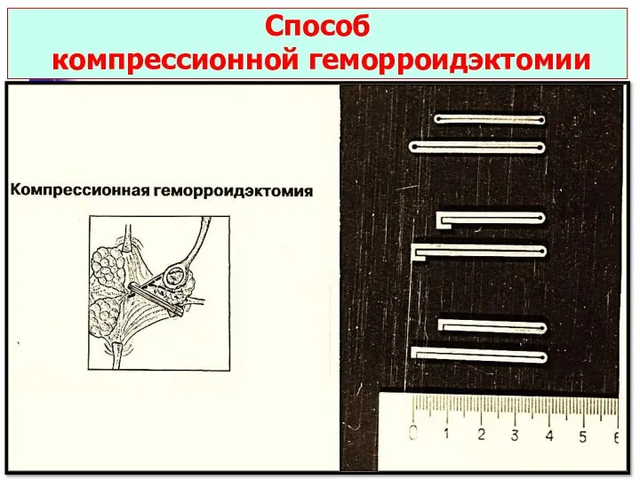 Способ компрессионной геморроидэктомии