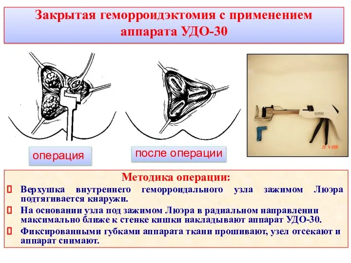 Закрытая геморроидэктомия с применением аппарата УДО-30 операция после операции Методика операции: Верхушка