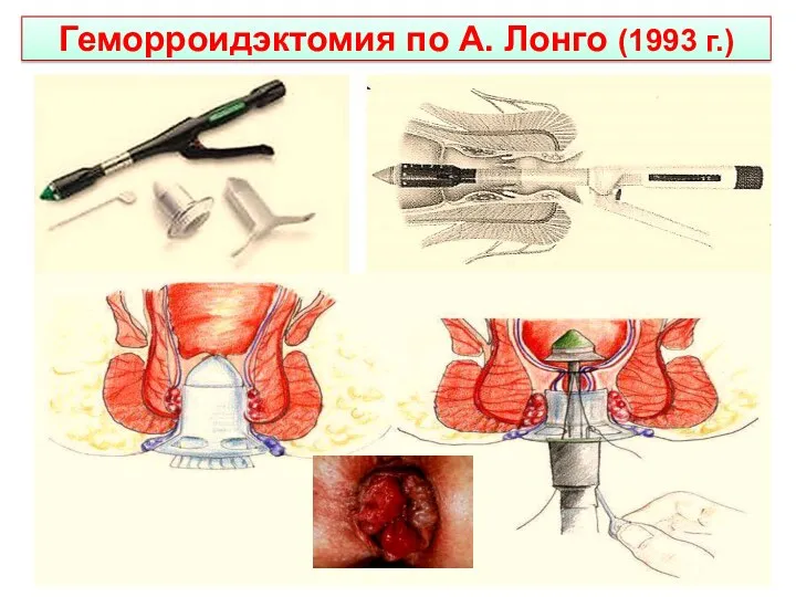 Геморроидэктомия по А. Лонго (1993 г.)