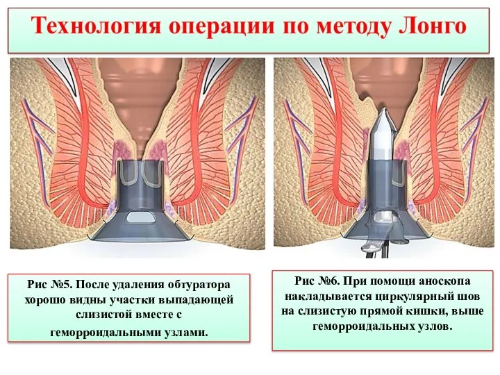 Рис №5. После удаления обтуратора хорошо видны участки выпадающей слизистой вместе с