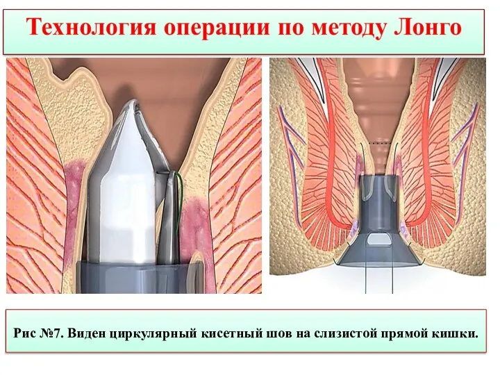 Рис №7. Виден циркулярный кисетный шов на слизистой прямой кишки.