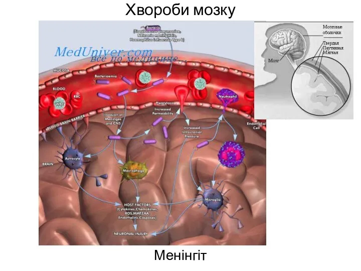 Хвороби мозку Менінгіт