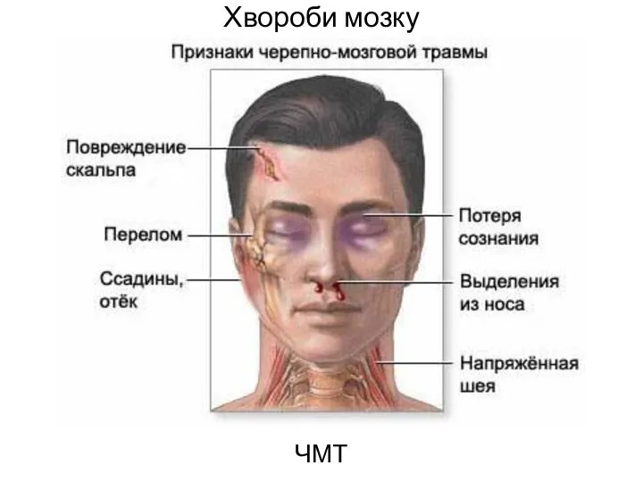 Хвороби мозку ЧМТ