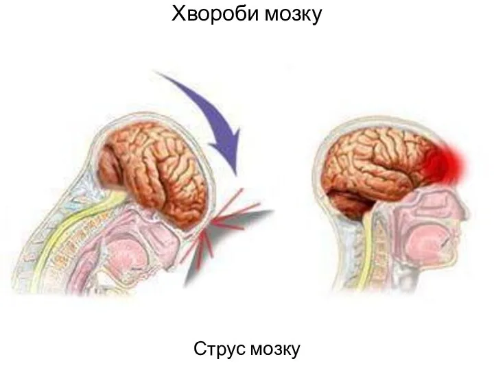 Хвороби мозку Струс мозку