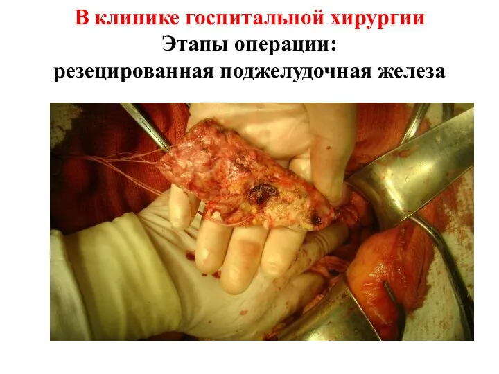 В клинике госпитальной хирургии Этапы операции: резецированная поджелудочная железа