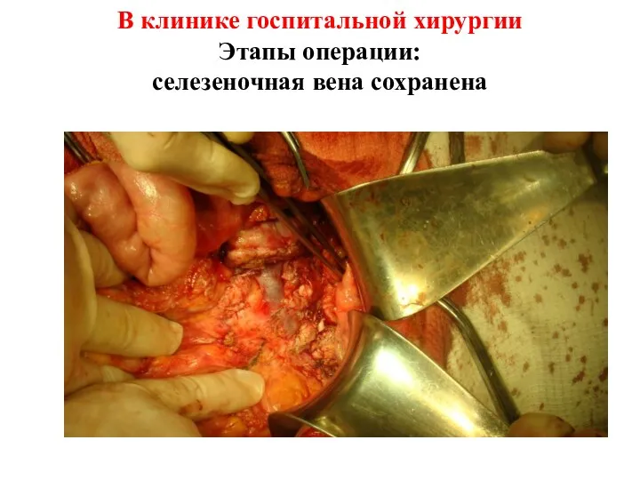 В клинике госпитальной хирургии Этапы операции: селезеночная вена сохранена