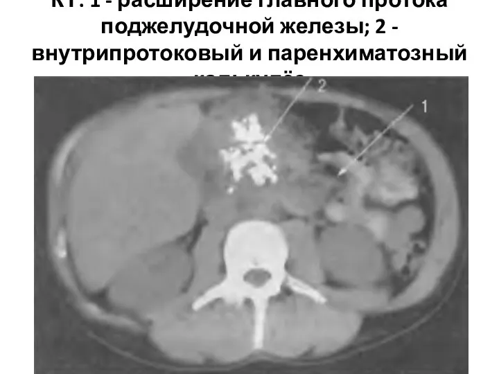 КТ: 1 - расширение главного протока поджелудочной железы; 2 - внутрипротоковый и паренхиматозный калькулёз