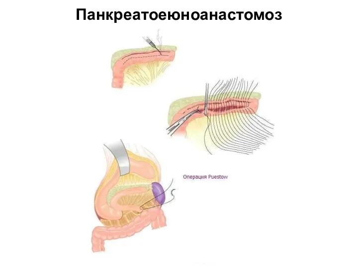 Панкреатоеюноанастомоз