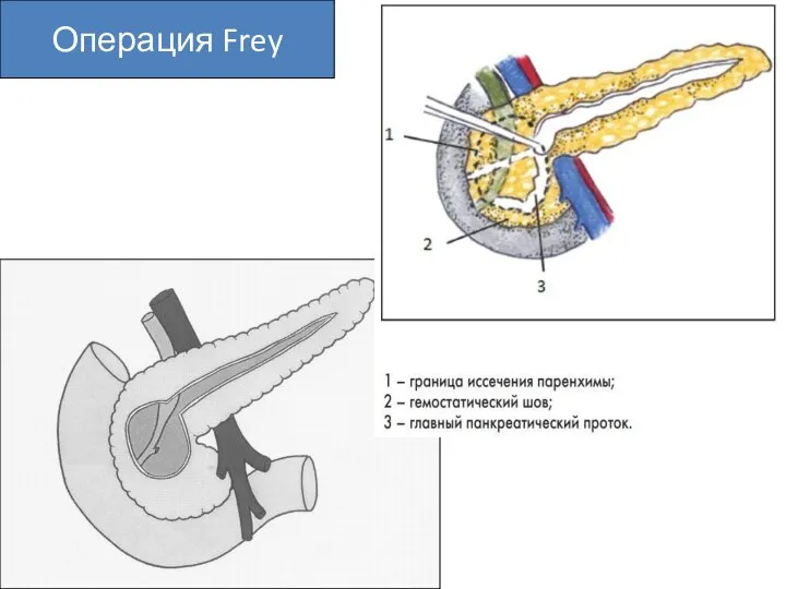 Операция Frey