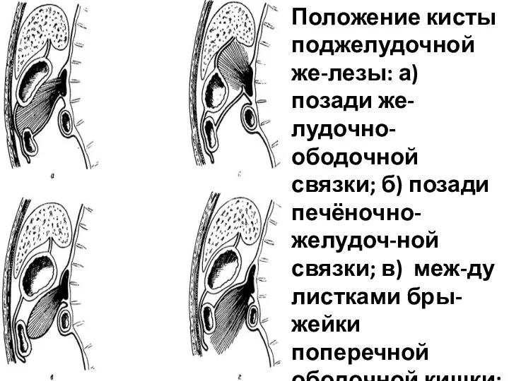 Положение кисты поджелудочной же-лезы: а) позади же-лудочно-ободочной связки; б) позади печёночно-желудоч-ной связки;