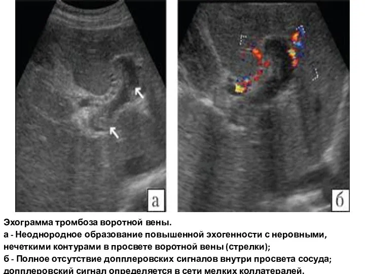 Эхограмма тромбоза воротной вены. а - Неоднородное образование повышенной эхогенности с неровными,