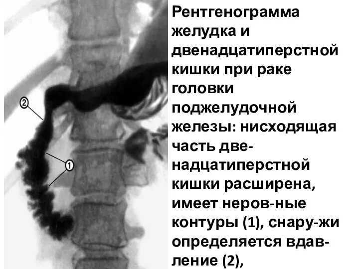 Рентгенограмма желудка и двенадцатиперстной кишки при раке головки поджелудочной железы: нисходящая часть
