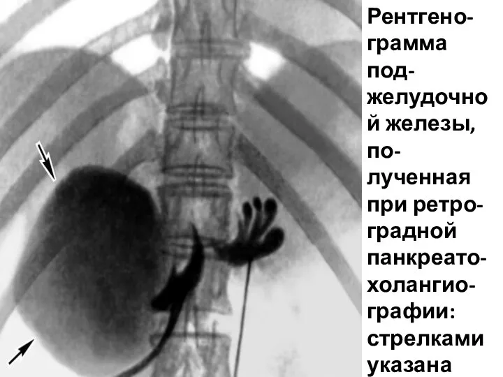 Рентгено-грамма под-желудочной железы, по-лученная при ретро-градной панкреато-холангио-графии: стрелками указана большая киста в головке под-желудочной железы.