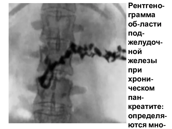 Рентгено-грамма об-ласти под-желудоч-ной железы при хрони-ческом пан-креатите: определя-ются мно-жествен-ные камни по ходу панкреа-тического протока.