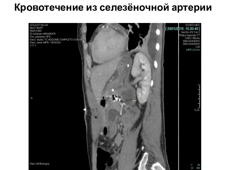 Кровотечение из селезёночной артерии