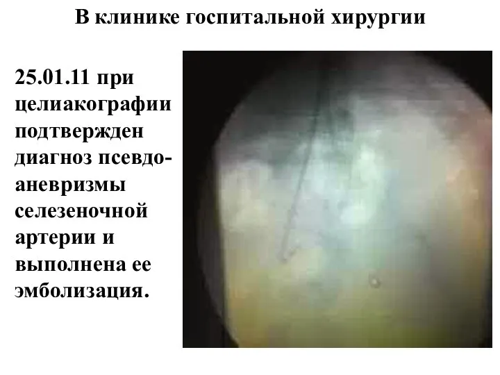 25.01.11 при целиакографии подтвержден диагноз псевдо-аневризмы селезеночной артерии и выполнена ее эмболизация. В клинике госпитальной хирургии